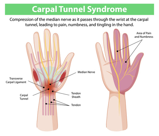 Carpal tunnel syndrome anatomy diagram showing median nerve compression and hand numbness