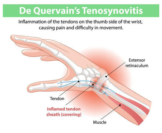Medical diagram of De Quervain's tenosynovitis showing inflamed tendon sheath on thumb side of wrist