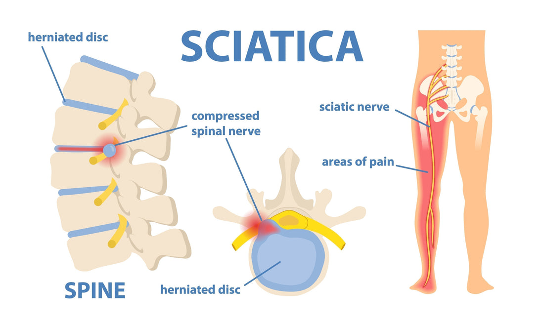 Medical diagram of sciatica showing herniated disc compressing spinal nerve, sciatic nerve pathway, and areas of pain radiating down the leg
