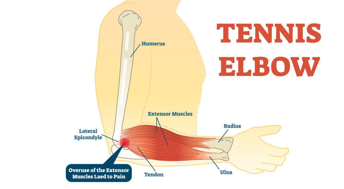 Medical anatomy diagram of tennis elbow showing humerus, lateral epicondyle, extensor muscles, tendon, radius, and ulna with overuse injury causing pain at elbow