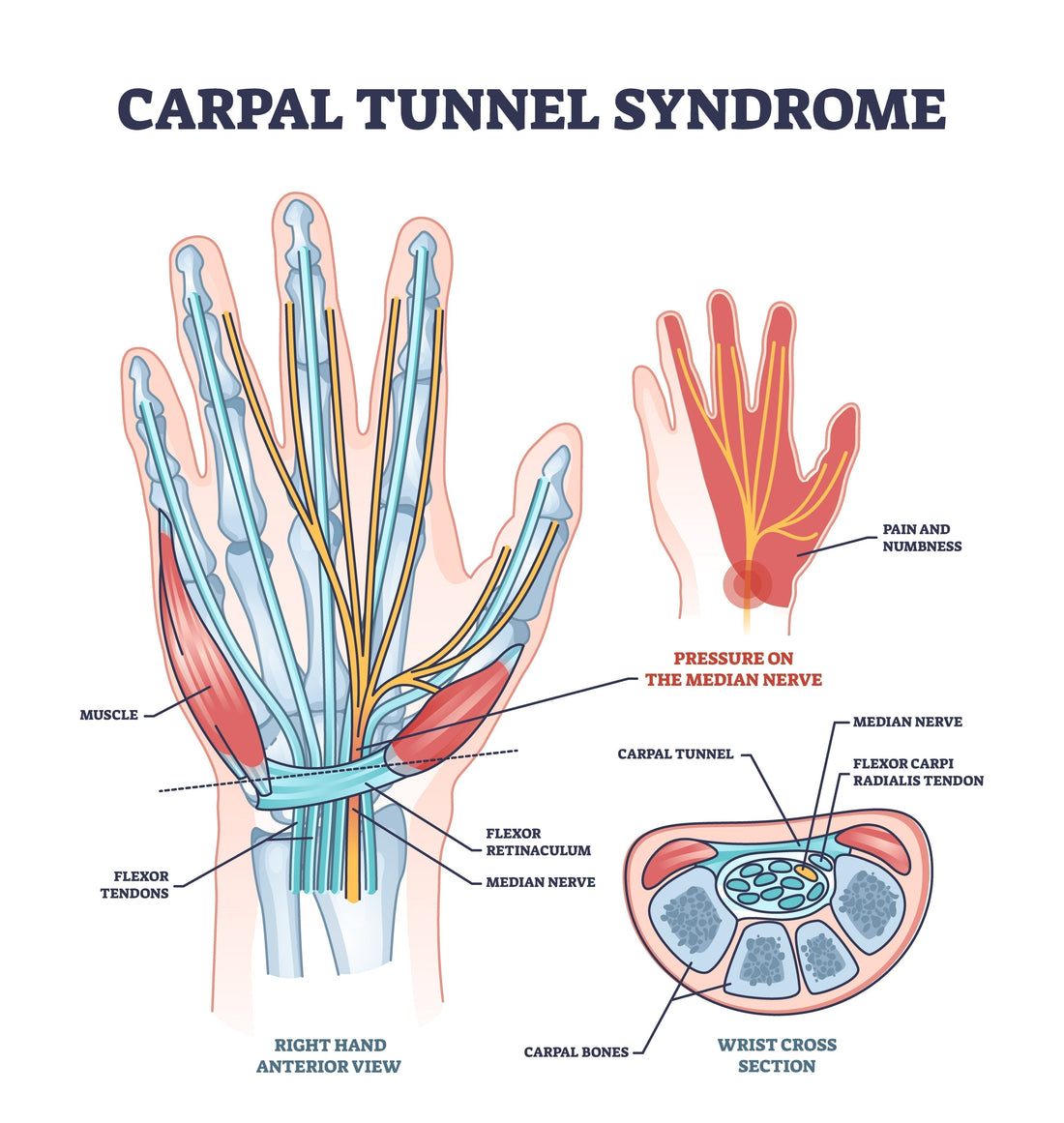 Medical diagram of carpal tunnel syndrome showing median nerve compression, flexor tendons, and wrist cross-section anatomy