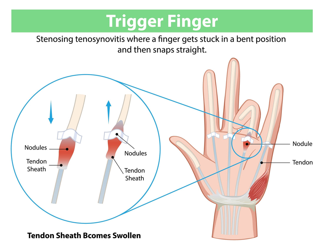 Medical anatomy diagram of trigger finger showing stenosing tenosynovitis, swollen tendon sheath, nodules, and finger locking mechanism in the palm
