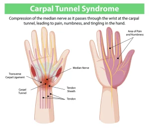 Carpal Tunnel