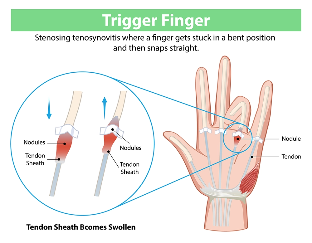 Trigger finger splint for pain relief and finger support