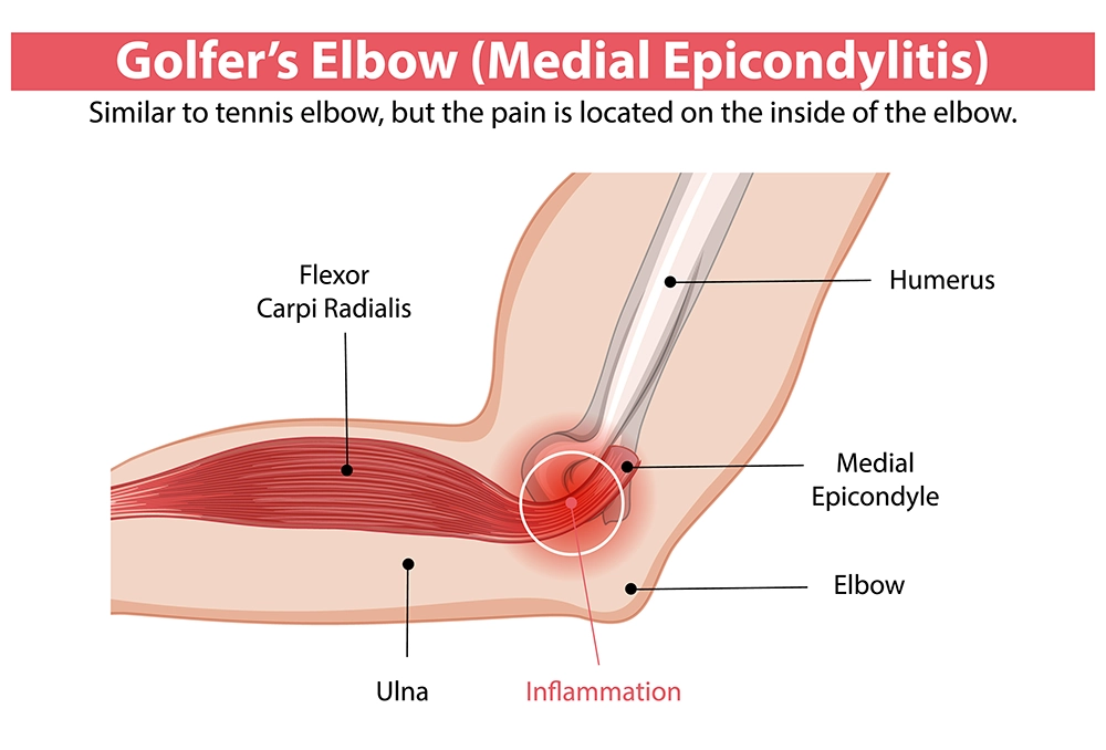 golfer's elbow medial epicondylitis inflammation diagram