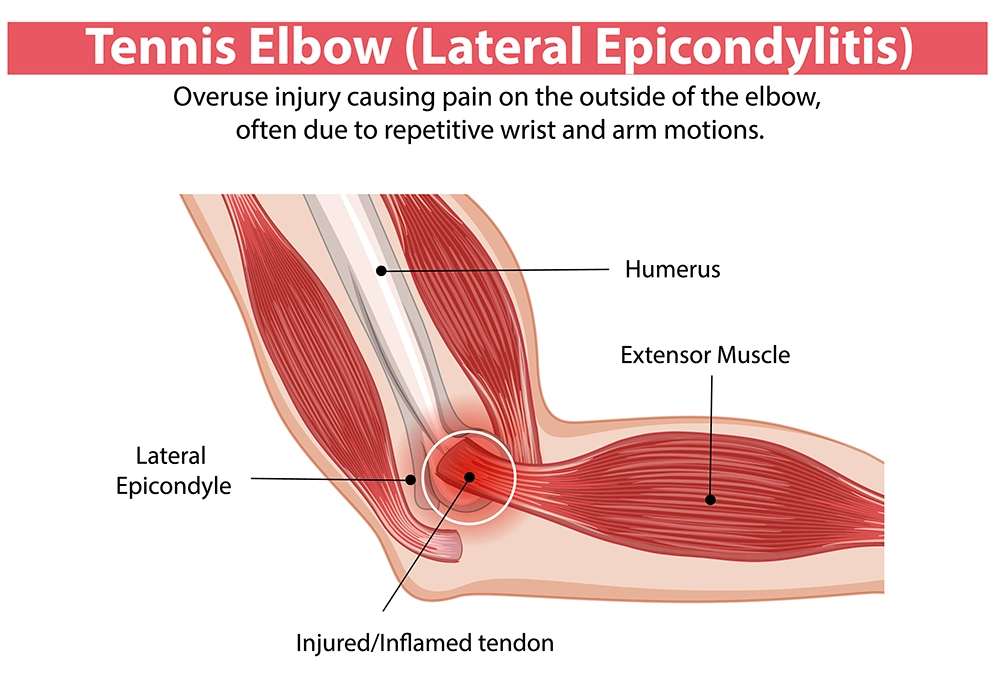 tennis elbow lateral epicondylitis inflammation diagram