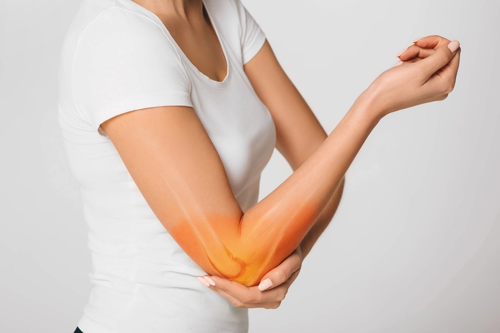 Elbow bursitis showing swelling of the olecranon bursa at the tip of the elbow